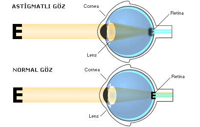 astigmat