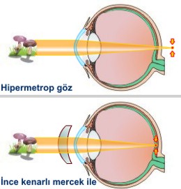 hipermetrop