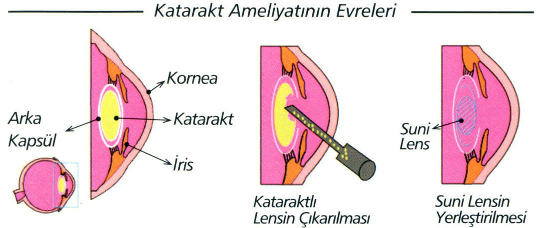 katarakt